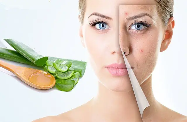 Cách Làm Mặt Nạ Nha Đam Trị Mụn Tại Nhà Đơn Giản, Hiệu Quả