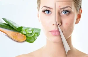 Cách Làm Mặt Nạ Nha Đam Trị Mụn: 5 Công Thức Đơn Giản Tại Nhà